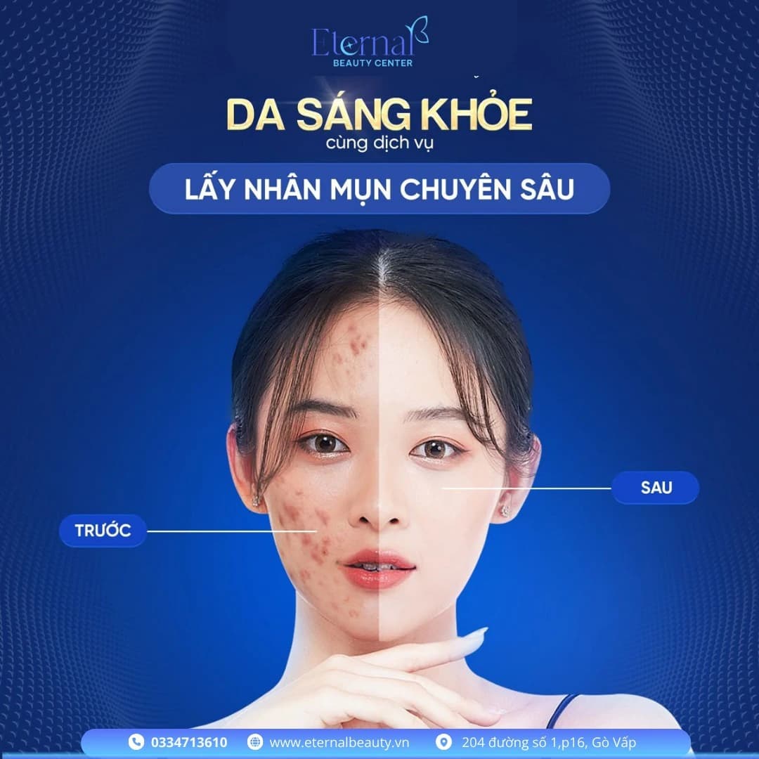 Eternal Peel – thay da sinh học không bong tróc tại Eternal Beauty Center Gò Vấp
