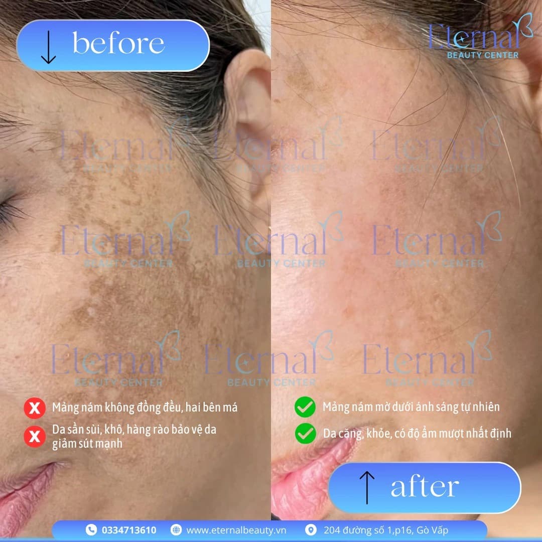 Before and after melasma treatment with the E-Mela protocol at Eternal Beauty Center