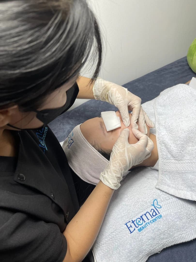Lấy nhân mụn kết hợp O2 Peel tại Eternal Beauty Center Gò Vấp