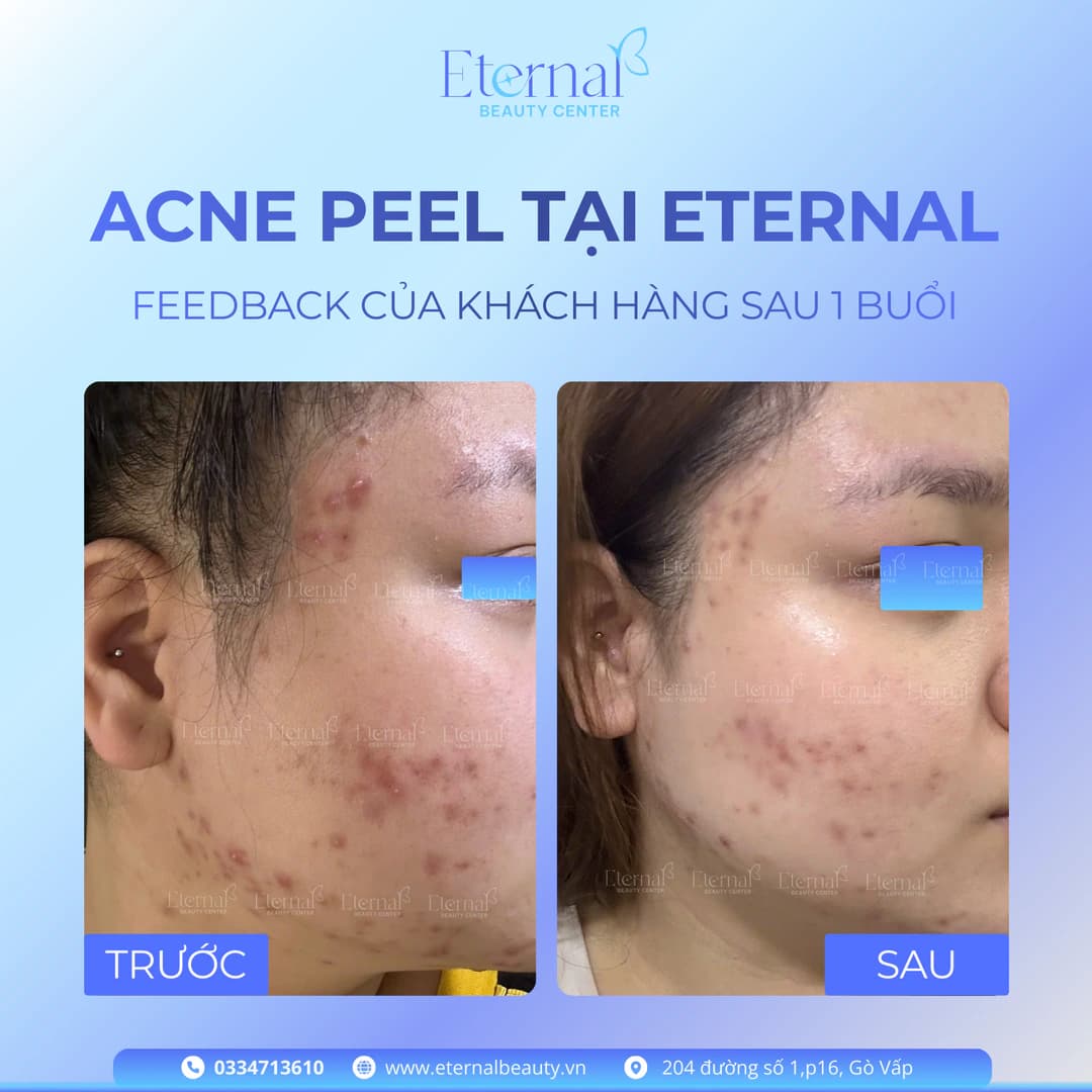 Feedback khách hàng sau 1 buổi Acne Peel tại Eternal: giảm mụn viêm và thông thoáng bề mặt da