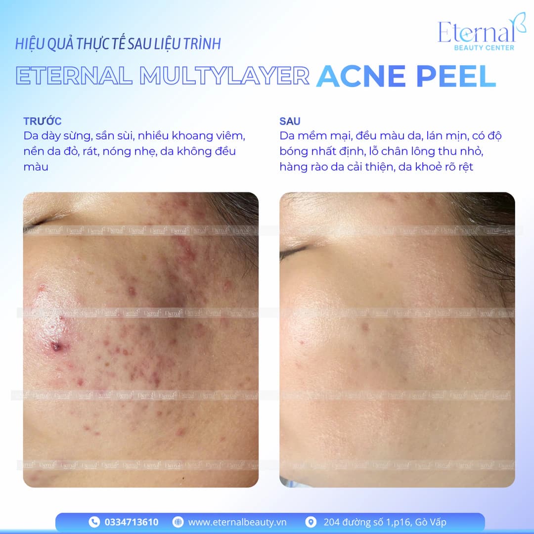 Trước và sau Acne Peel: da sạch ổ viêm, mờ thâm mụn, chất lượng da mịn màng hơn