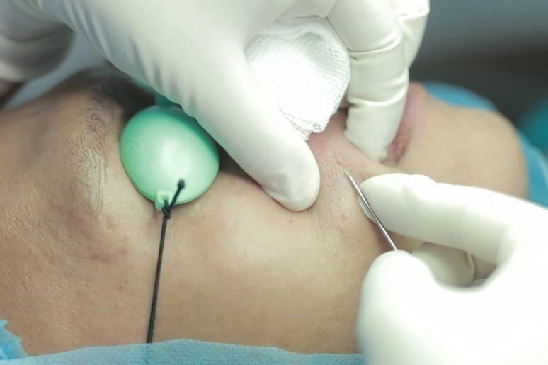 Cắt đáy sẹo rỗ lượn sóng bằng kim Nokor