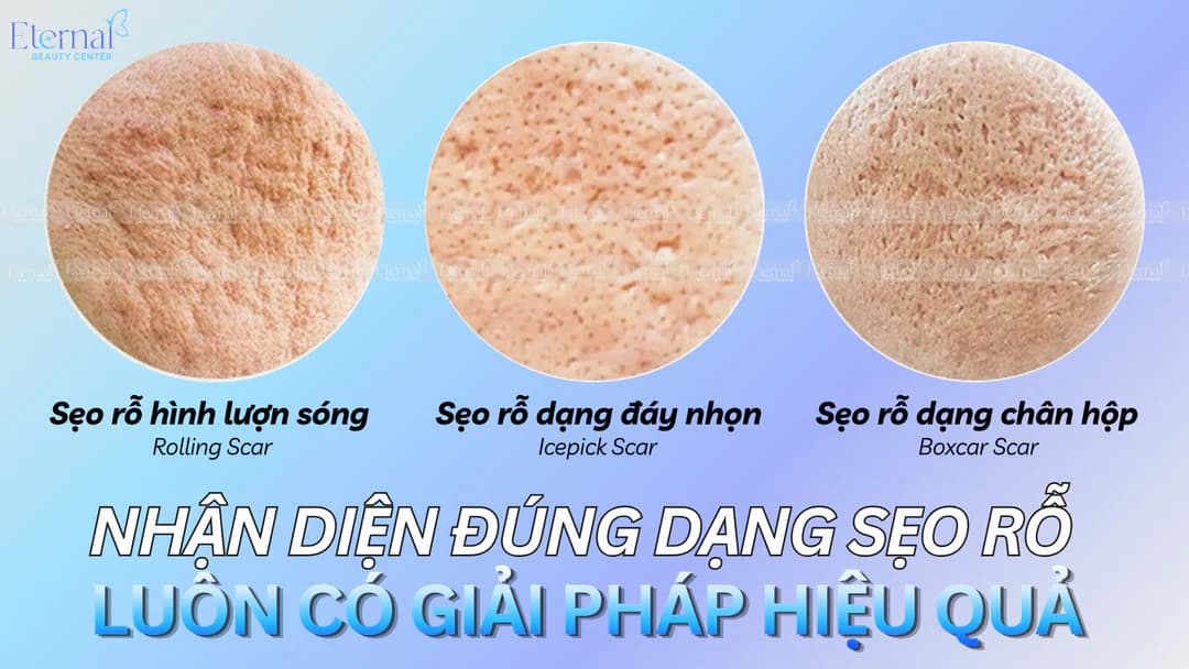 Các loại sẹo rỗ thường gặp