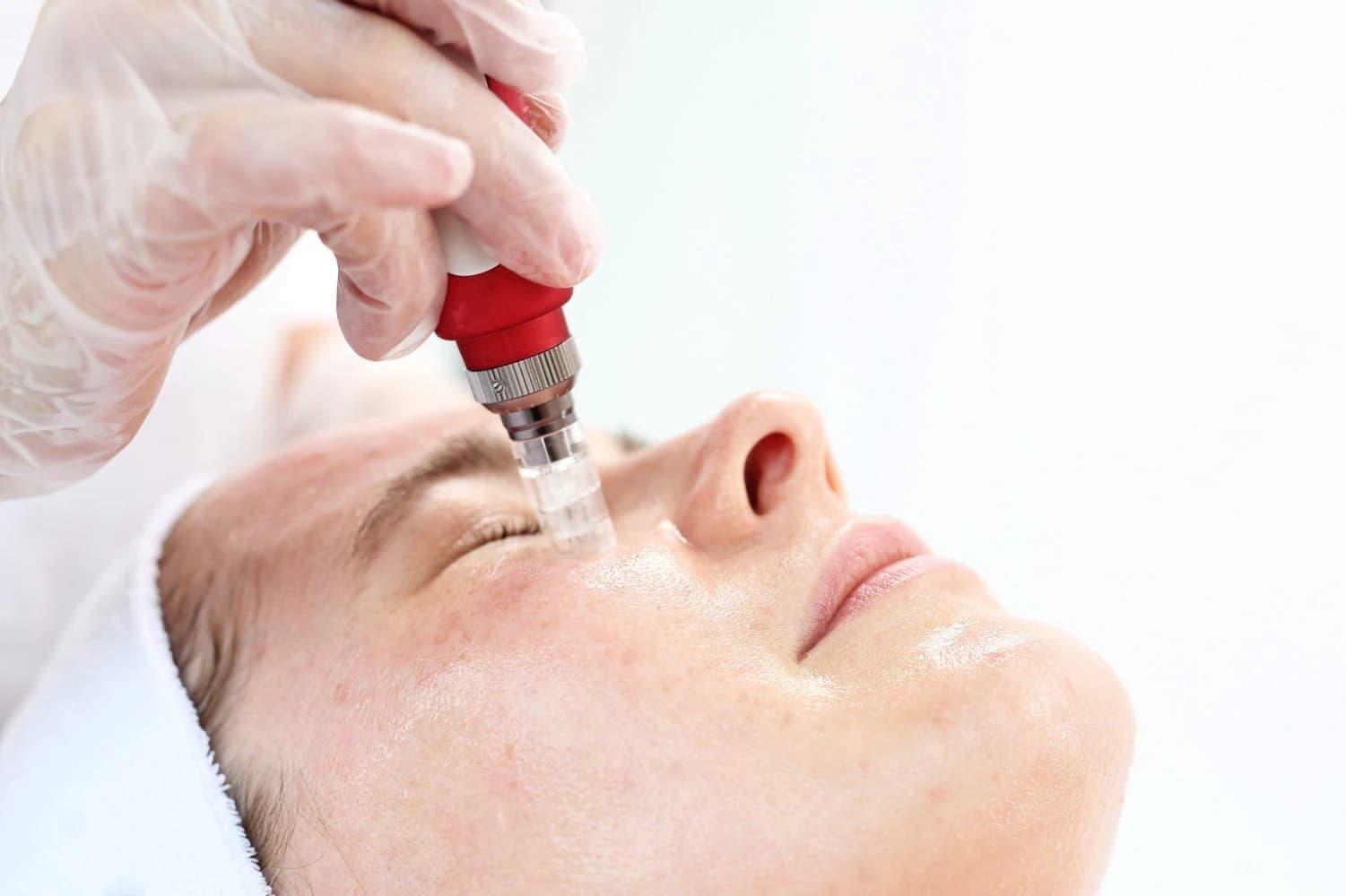 Phi kim vi điểm kích thích tăng sinh collagen làm đầy sẹo rỗ