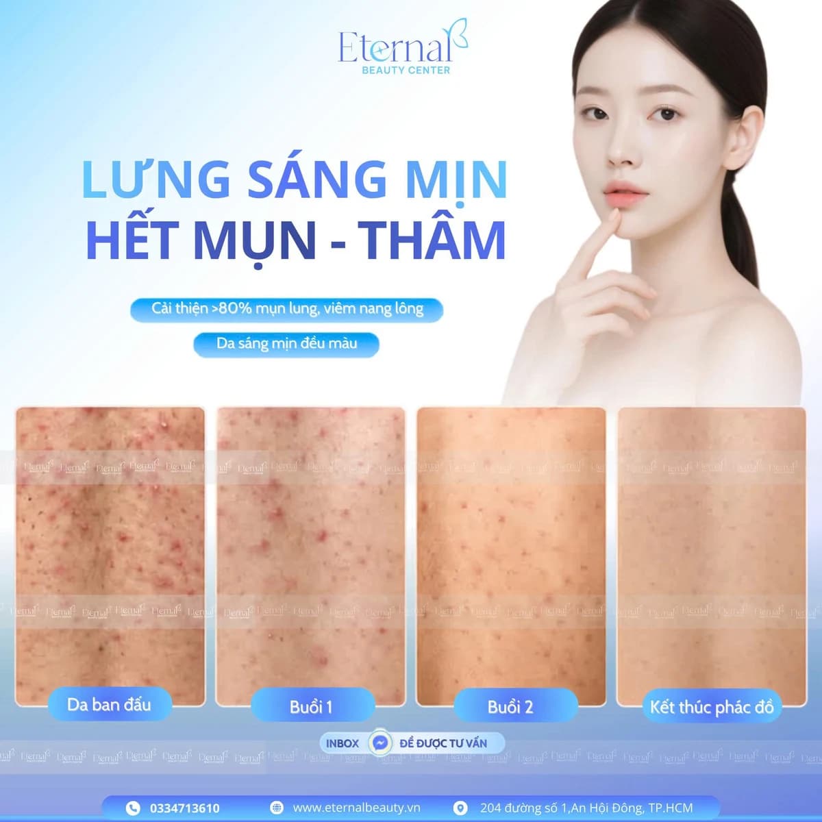 Back Peel – Điều trị mụn lưng chuẩn y khoa