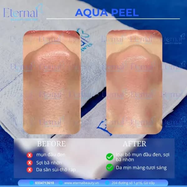 Aquapeel – làm sạch da chuyên sâu và cấp ẩm chuẩn Hàn tại Eternal Beauty Center Gò Vấp