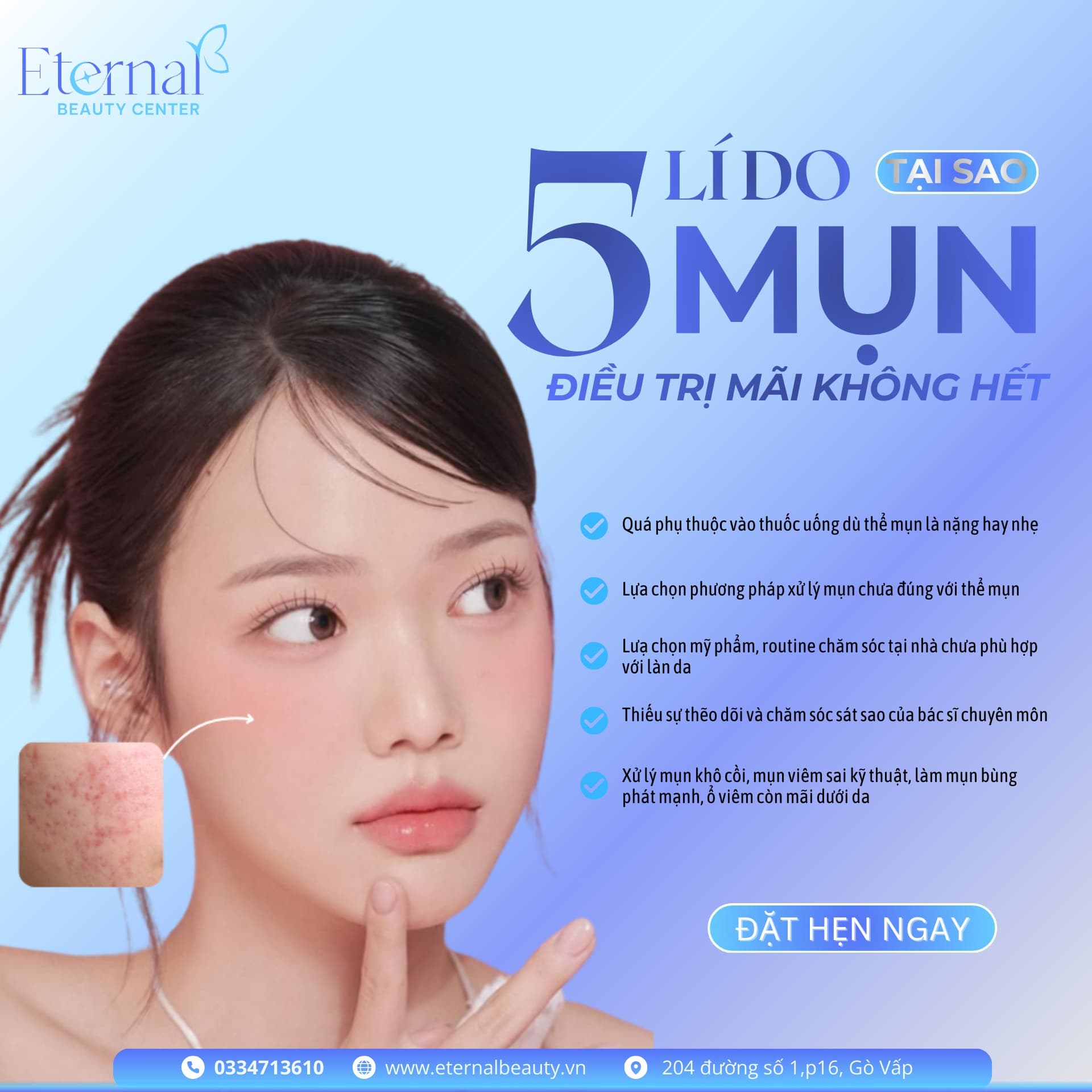 Everything You Need to Know About Acne