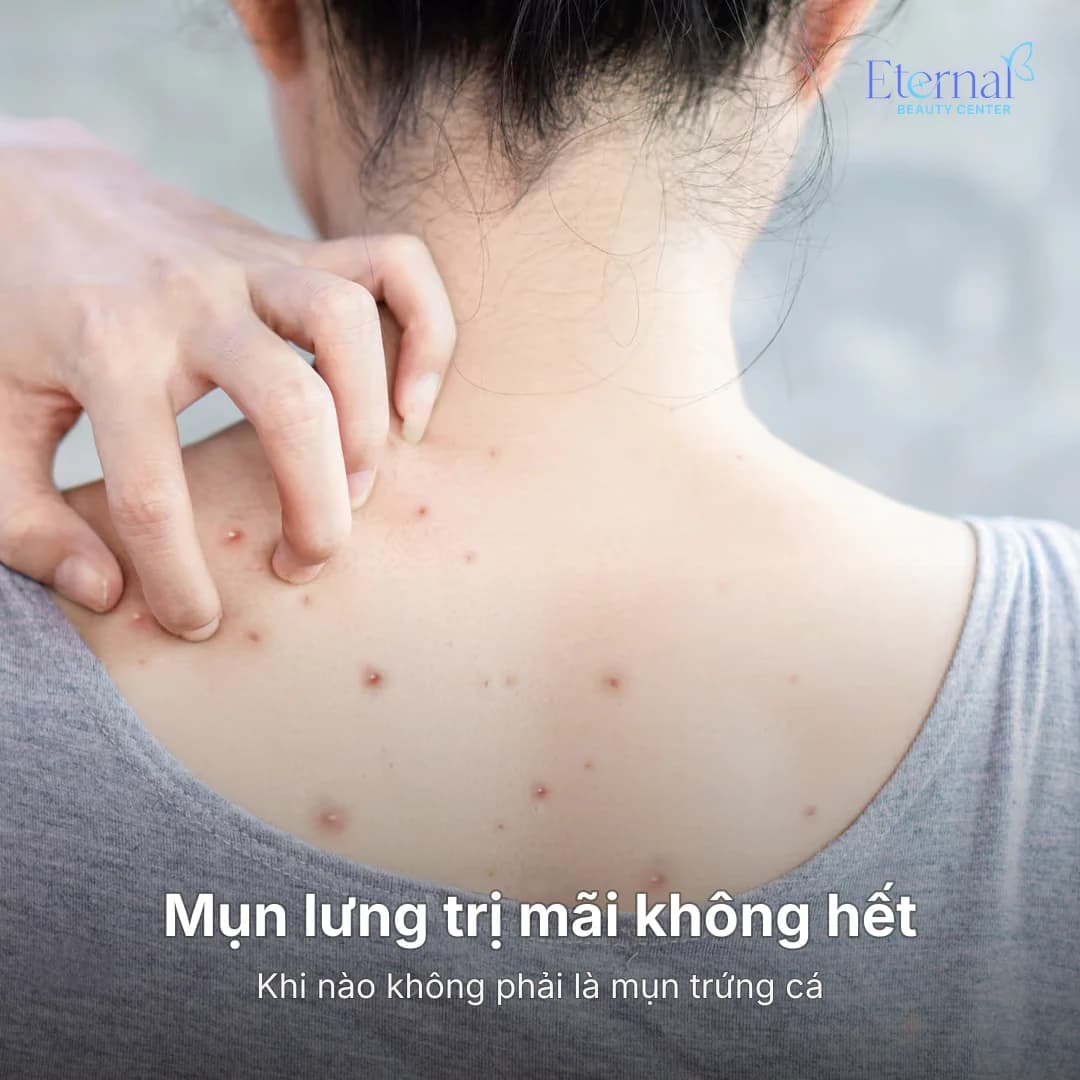 Mụn lưng trị mãi không hết: khi nào không phải là mụn trứng cá