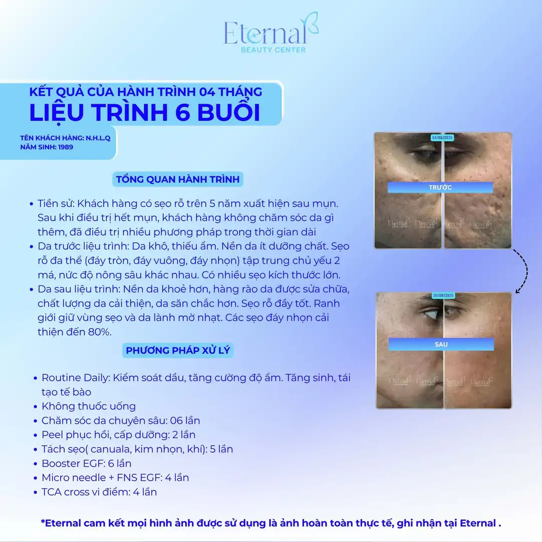 Hồ sơ thực tế: cải thiện sẹo rỗ lâu năm (rolling, boxcar, ice pick) sau liệu trình xử lý sẹo tại Eternal Beauty Center