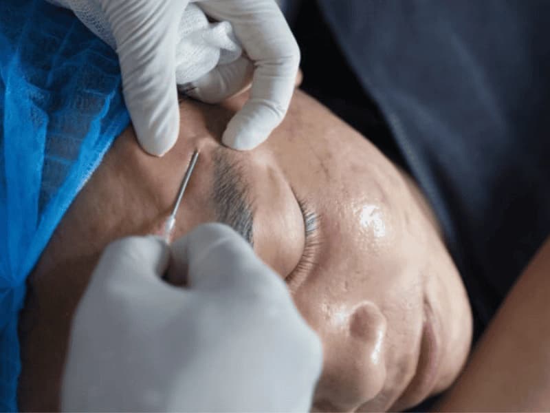 Bóc tách đáy sẹo rỗ diện rộng bằng kim Cannula