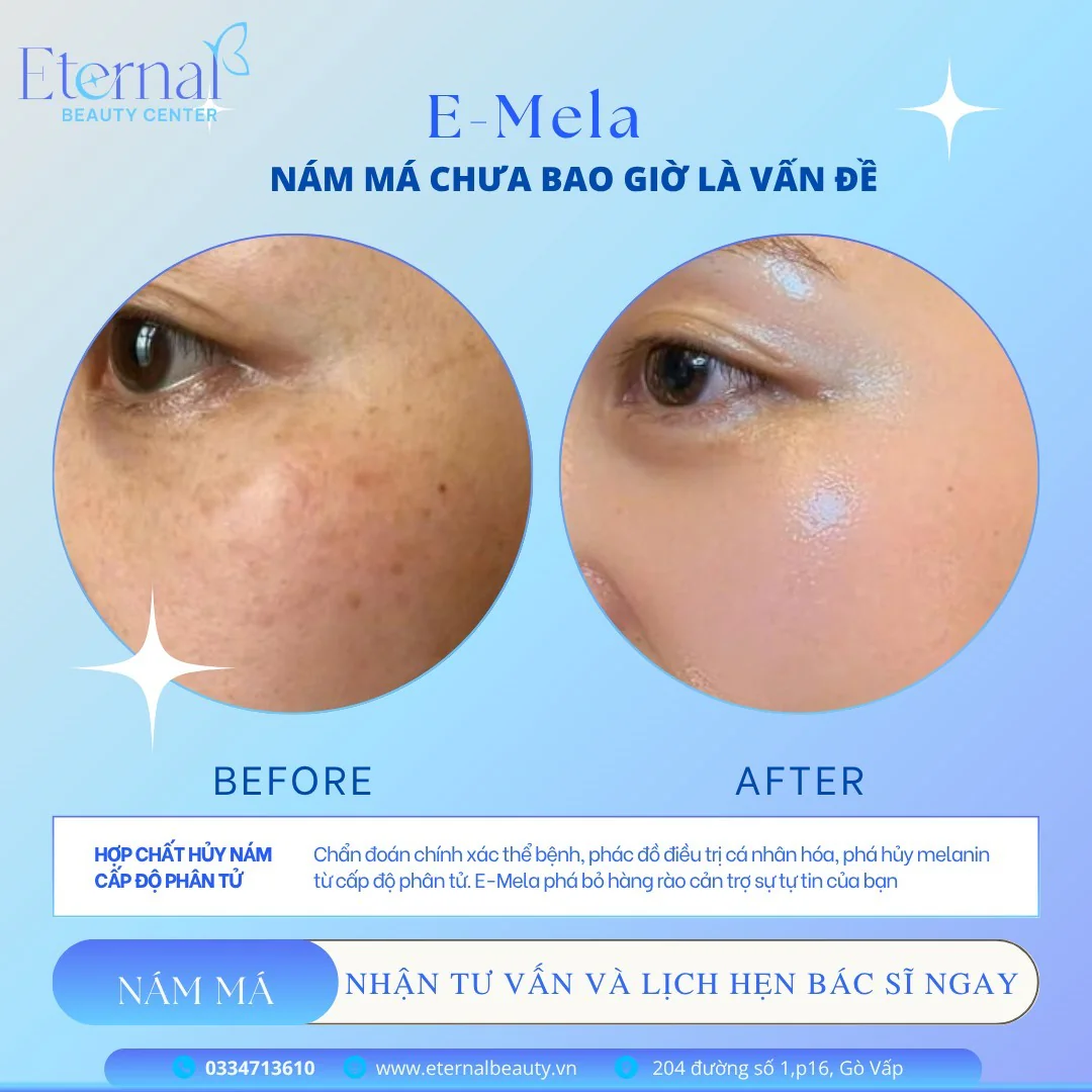 Before and after an E-Mela melasma treatment course at Eternal Beauty Center