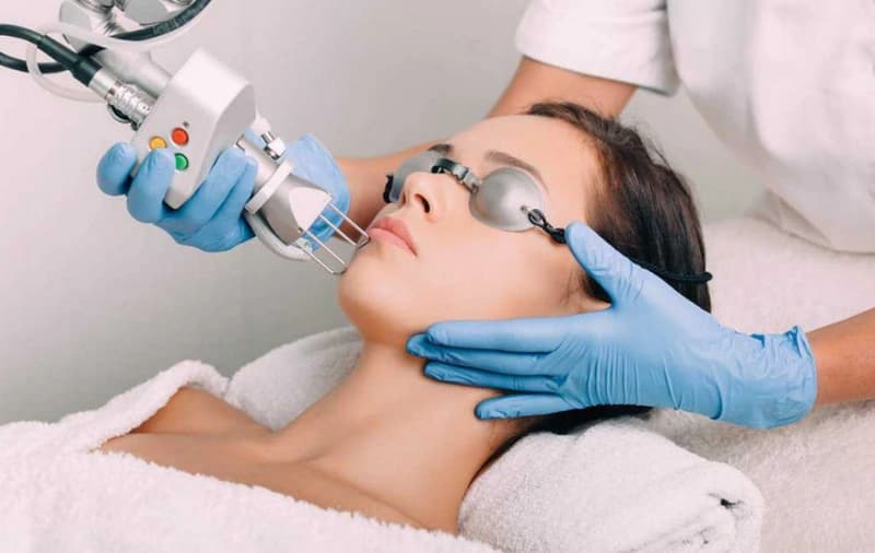 Laser Fractional CO2 điều trị sẹo rỗ