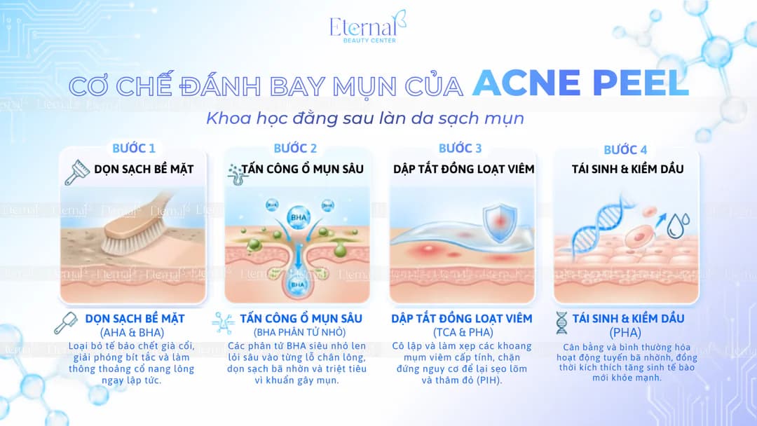 Bốn cơ chế đánh bay mụn của Acne Peel: dọn sạch bề mặt, tấn công ổ mụn sâu, dập tắt viêm và tái sinh kiểm dầu