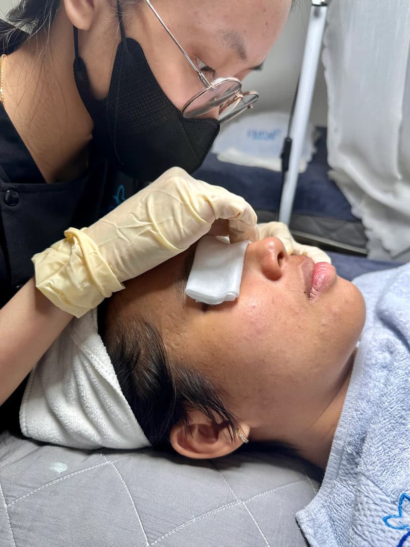Da được làm mềm bằng O2 Peel trước khi lấy nhân mụn tại Eternal