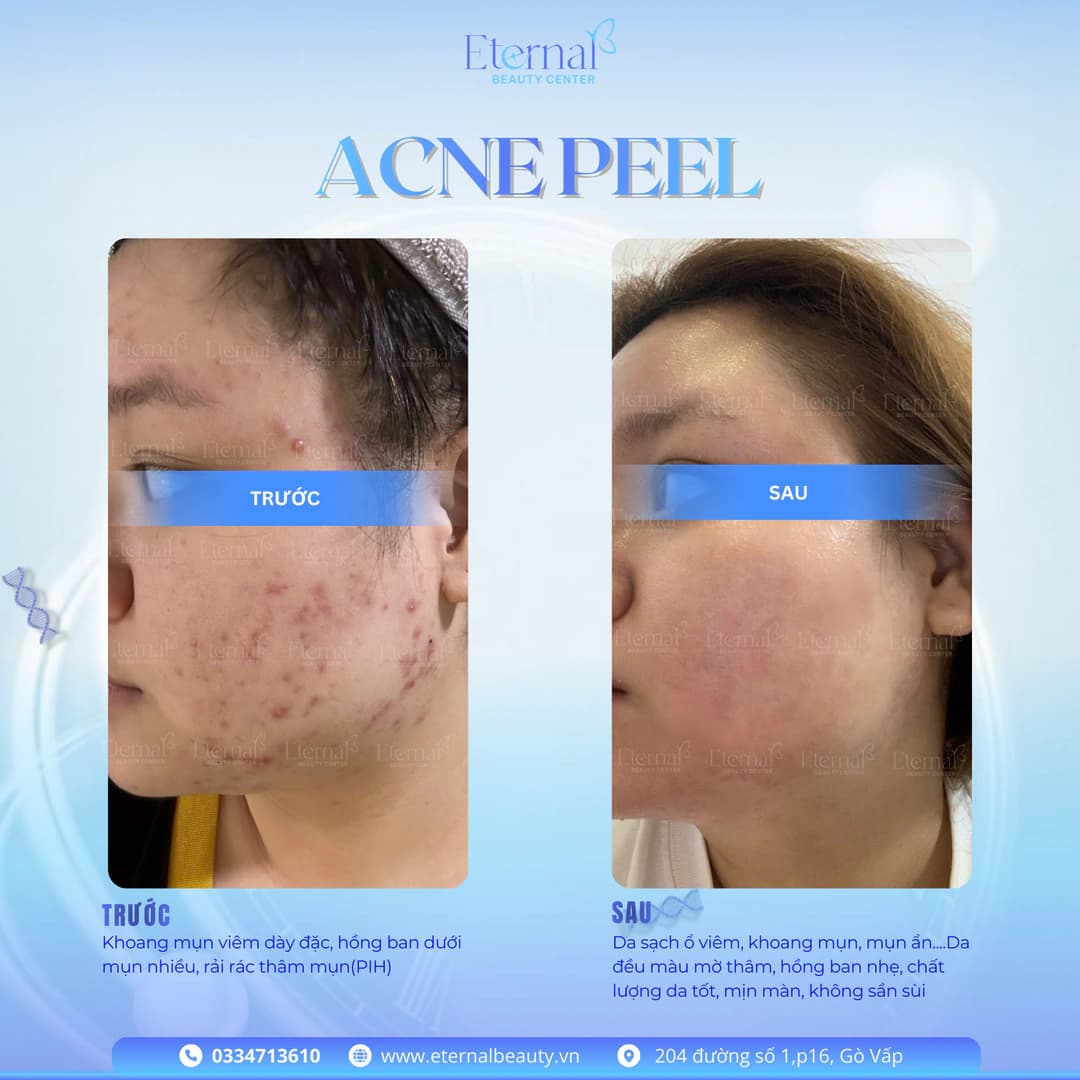 Hiệu quả thực tế sau liệu trình Eternal Multylayer Acne Peel: da mềm mại, đều màu, lỗ chân lông thu nhỏ, hàng rào da cải thiện