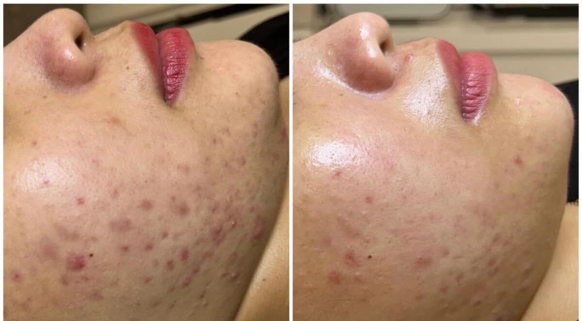 Hình ảnh trước và sau liệu trình scar peel cho sẹo nông