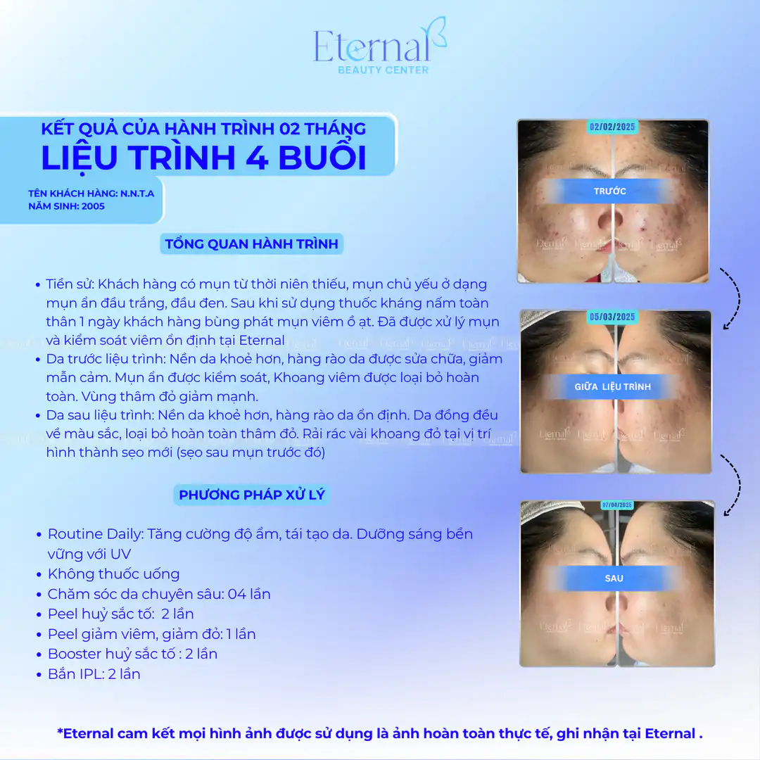 Real Treatment Journeys at Eternal Beauty Center: Acne, Post Acne Pigmentation, and Acne Scar Cases