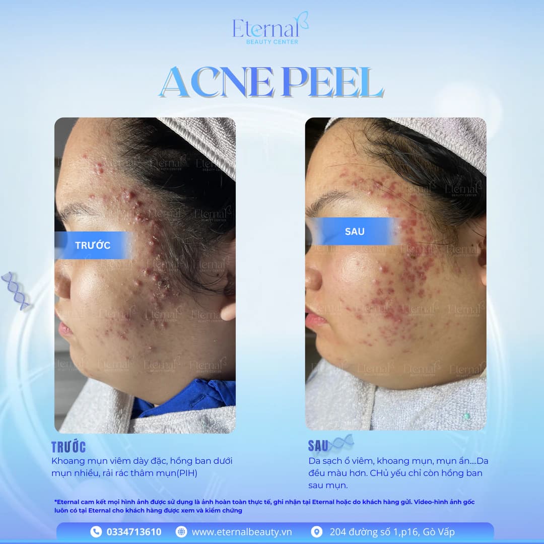 Trước và sau Acne Peel tại Eternal: giảm khoang mụn viêm, da đều màu hơn, chủ yếu còn hồng ban sau mụn