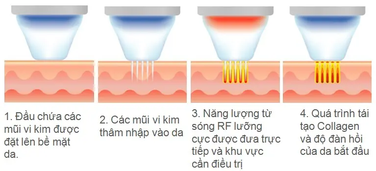 Vi kim RF kết hợp sóng tần số vô tuyến xử lý sẹo rỗ trên da tối màu