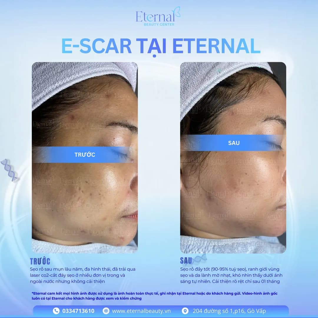 Hình ảnh trước và sau liệu trình E-Scar tại Eternal — khách hàng sẹo rỗ lâu năm