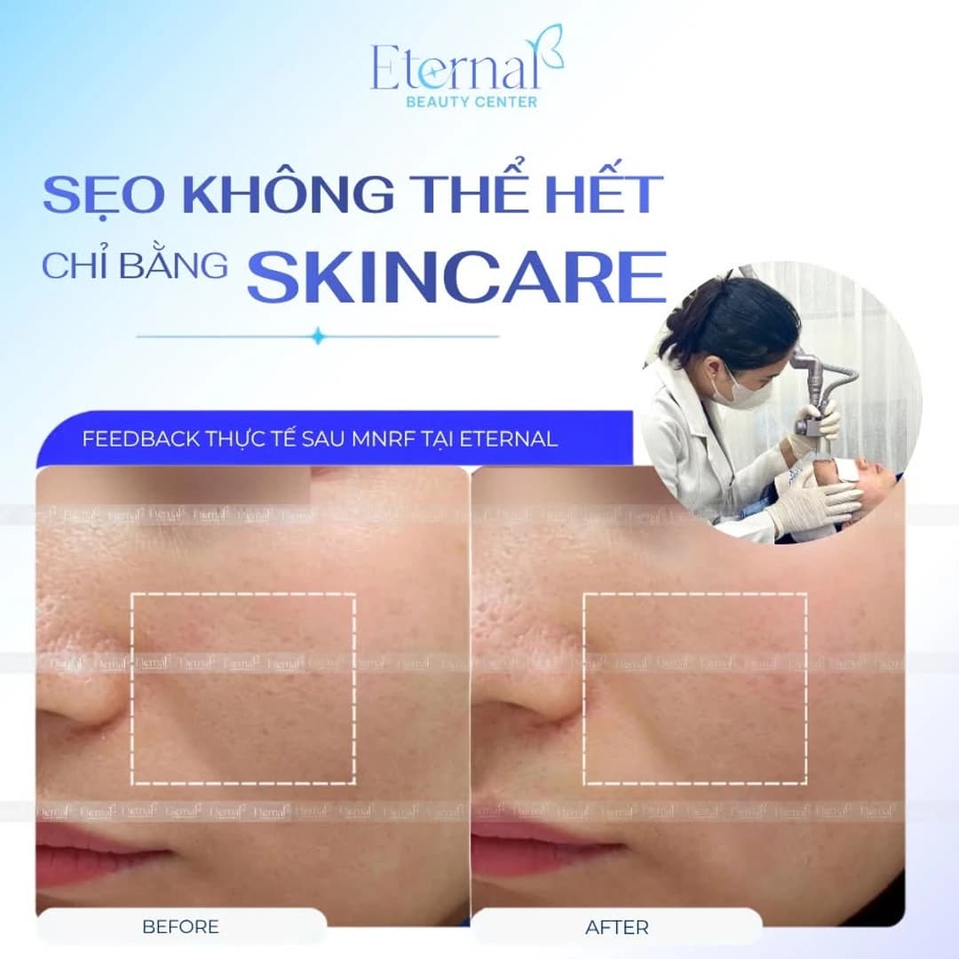Do scar creams and topical treatments work? Why depressed scars don't fill in, however long you apply them