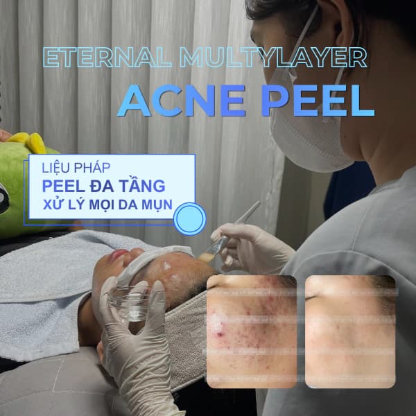Acne Peel – Protocol for Oily, Acne-Prone Skin
