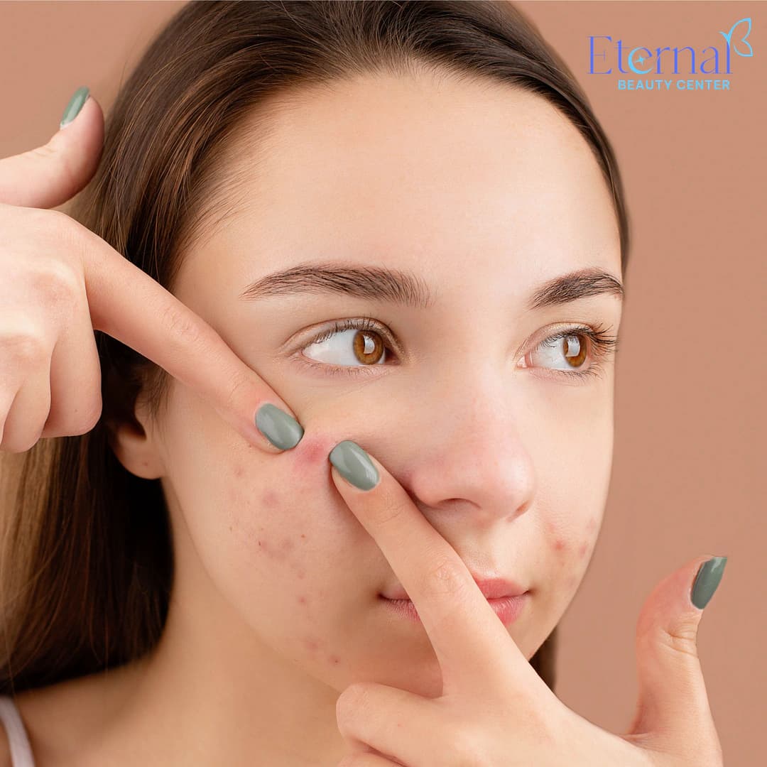 Mụn ẩn có tự hết không? Giải đáp từ chuyên gia và cách xử lý đúng