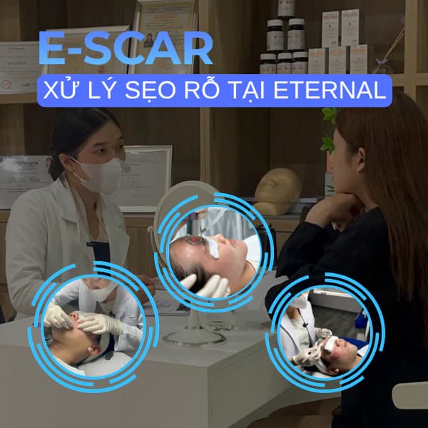 E-Scar – Medical Acne Scar Treatment