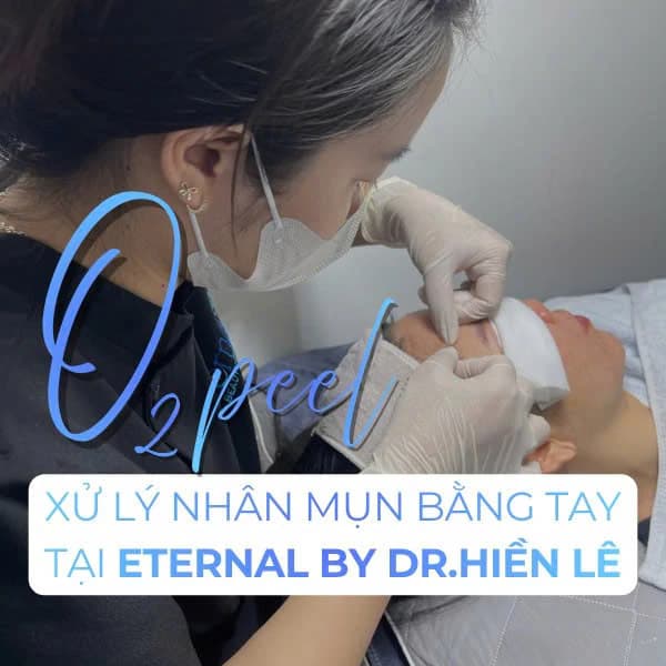 O2 Peel – Manual Acne Extraction